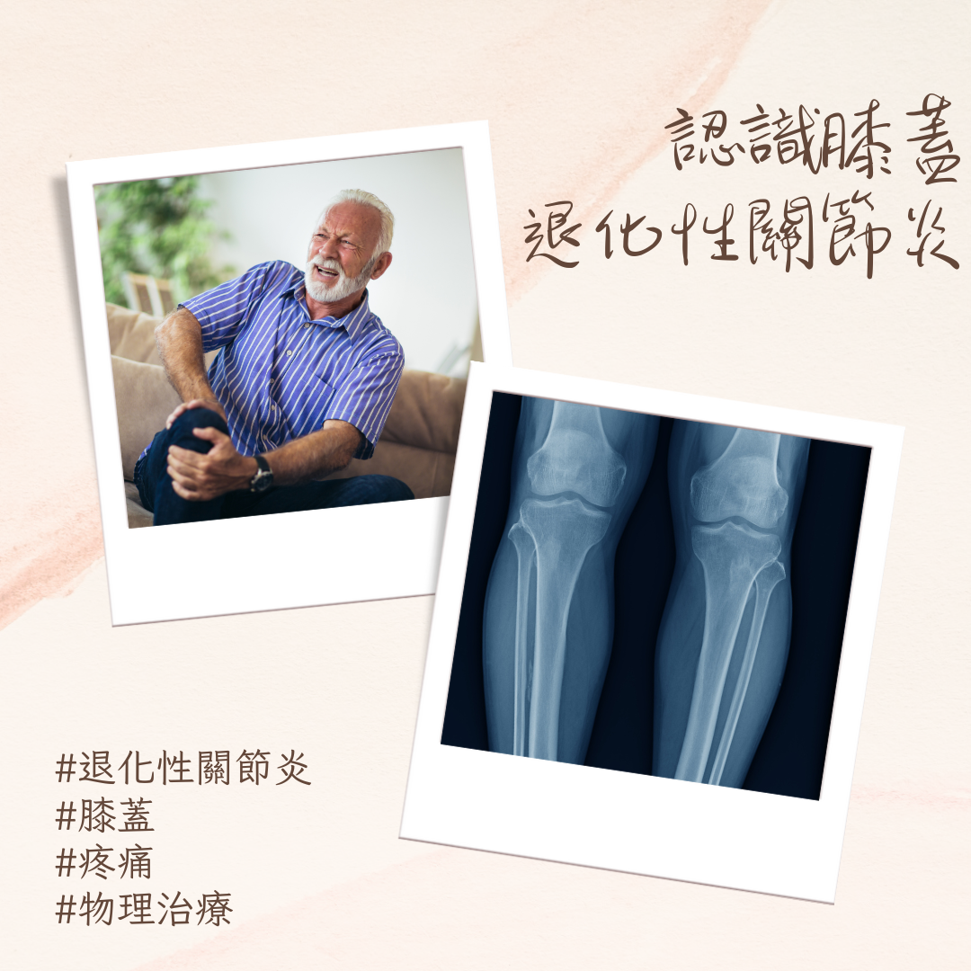 認識膝蓋退化性關節炎