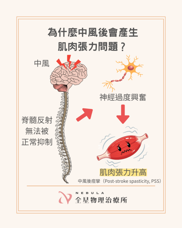 中風後痙攣的原因
